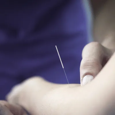 Close-up view of dry needling treatment on forearm muscle