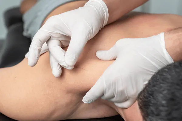 Tight Shoulders? Try Dry Needling Therapy