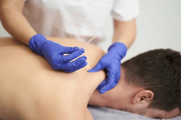 Gloved therapist inserts needle into patient's back during a dry needling therapy session for pain relief