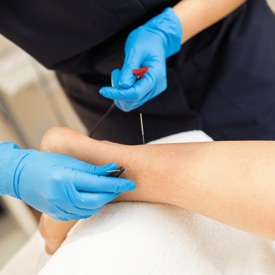 Practitioner holds needle near patient's leg during dry needling treatment