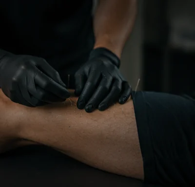 Sports physical therapist performing dry needling therapy on an athlete's leg for muscle tension and pain relief.
